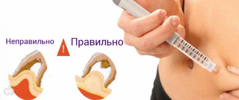 Как сделать укол клексана в животе Как сделать укол клексана в животе