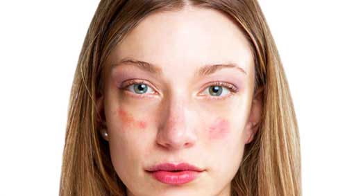 Mit mondanak vörös pelyhes foltok az arcon: a kezelés és a megelőzés módszerei - Gyermekekben
